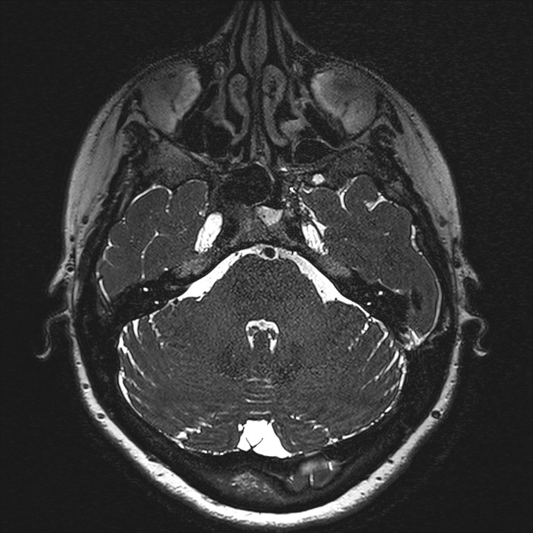 Anterior temporal encephalocele (Radiopaedia 82624-96808 Axial T2 high res 27).jpg