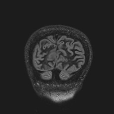 Anterior temporal encephalocele (Radiopaedia 82624-96808 Coronal FLAIR 48).jpg
