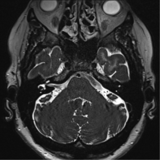 Anterior temporal pole cysts (Radiopaedia 46629-51102 Axial 4).png