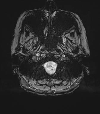 Anterior temporal pole cysts (Radiopaedia 46629-51102 Axial SWI 9).png