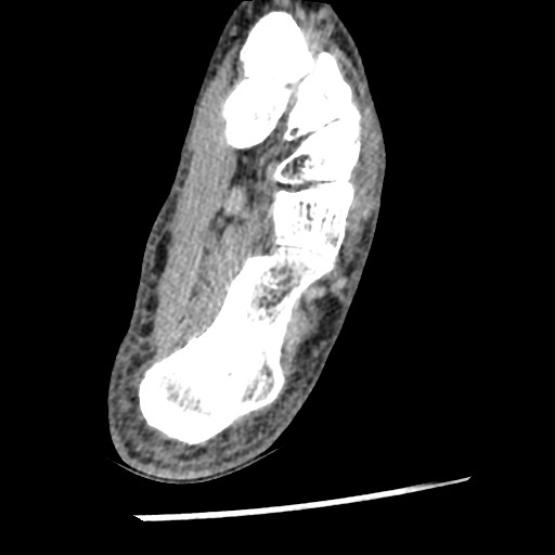Anterior tibial artery false aneurysm (Radiopaedia 88984-105809 A 201).jpg