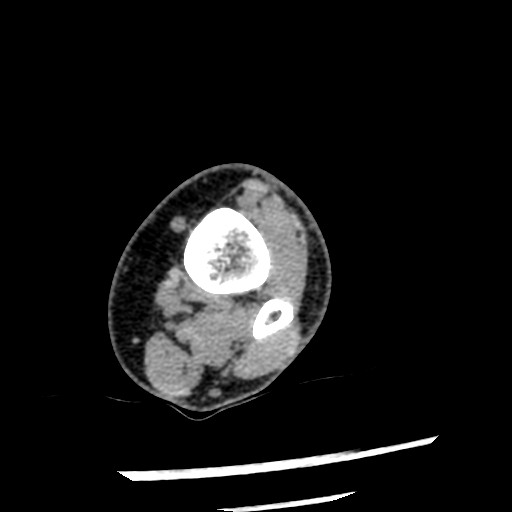 Anterior tibial artery false aneurysm (Radiopaedia 88984-105809 A 54).jpg