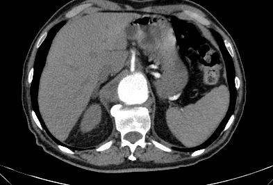 File:Anterior vertebral scalloping (abdominal aortic aneurysm) (Radiopaedia 66744-76067 F 6).jpg
