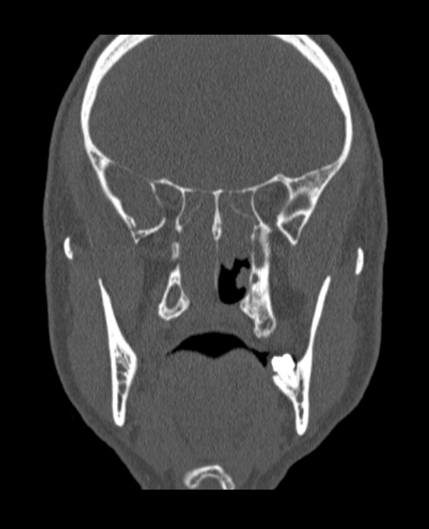 Antrochoanal polyp (Radiopaedia 79011-92169 Coronal bone window 32).jpg
