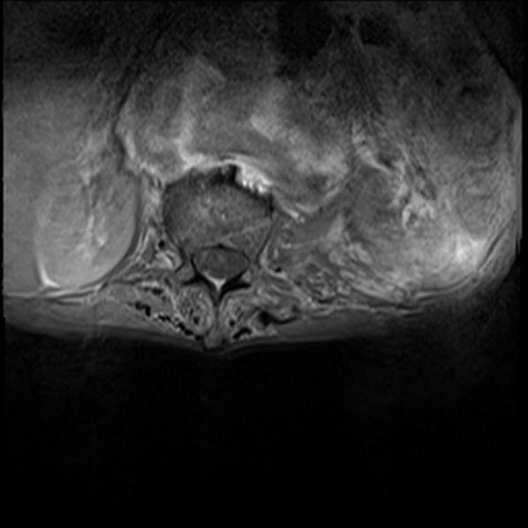 File:Aortic aneurysm with spinal destruction (Radiopaedia 42301-45409 Axial T1 fat sat 6).jpg