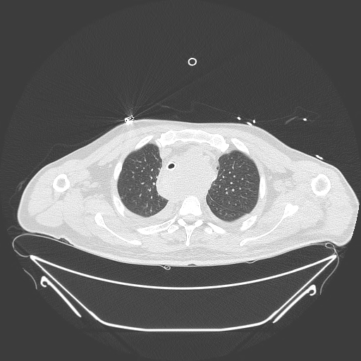 Aortic arch aneurysm (Radiopaedia 84109-99365 Axial lung window 78).jpg