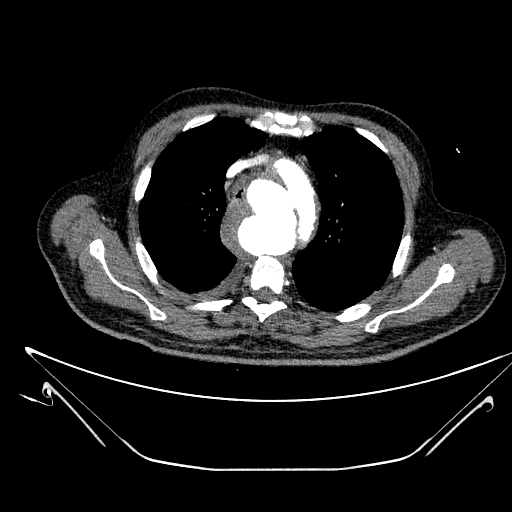 File:Aortic arch aneurysm (Radiopaedia 84109-99365 B 196).jpg