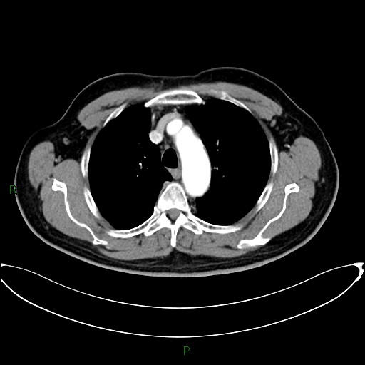 Aortic arch origin of left vertebral artery (Radiopaedia 46327-50737 Axial post contrast 34).jpg