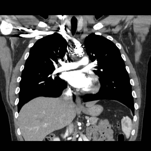 File:Aortic arch stent (Radiopaedia 30030-30595 F 13).jpg