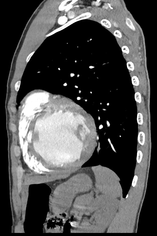Aortic coarctation with aneurysm (Radiopaedia 74818-85828 B 117).jpg