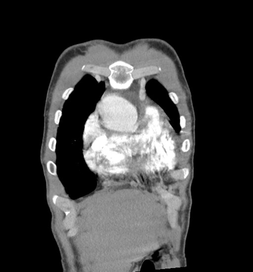 Aortic coarctation with aneurysm (Radiopaedia 74818-85828 C 17).jpg