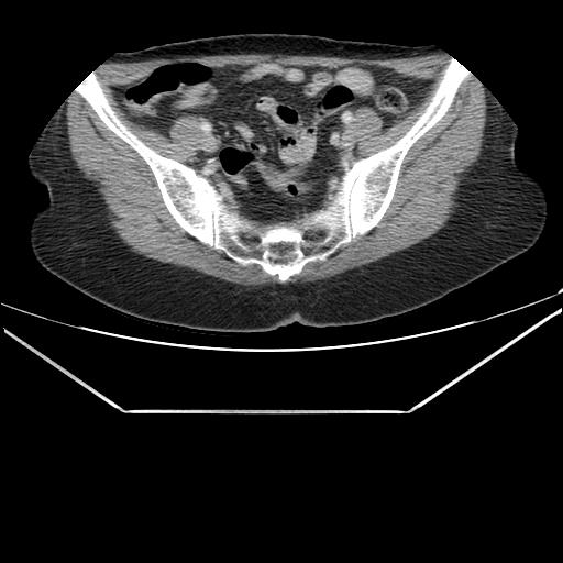 Aortic dissection (Radiopaedia 25350-25604 C 87).jpg
