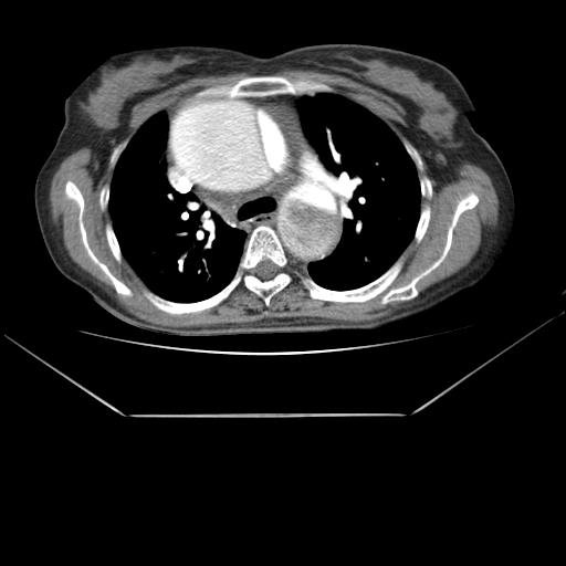 File:Aortic dissection (Radiopaedia 25350-25604 D 2).jpg
