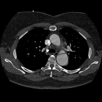 Aortic dissection (Radiopaedia 57969-64959 A 117).jpg