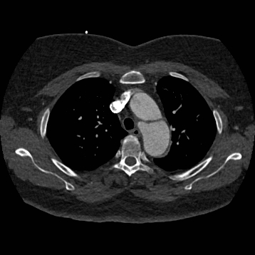 File:Aortic dissection (Radiopaedia 57969-64959 A 96).jpg
