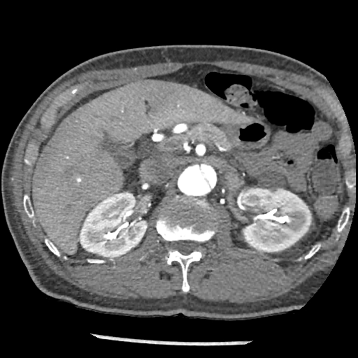 Aortic dissection - DeBakey Type I-Stanford A (Radiopaedia 79863-93115 A 45).jpg