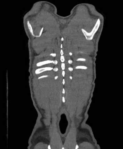 File:Aortic dissection - Stanford type B (Radiopaedia 73648-84437 B 113).jpg