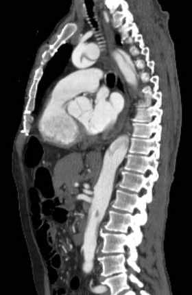 File:Aortic dissection - Stanford type B (Radiopaedia 73648-84437 C 70).jpg