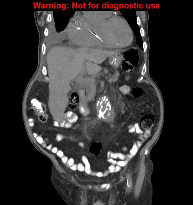 Aortic graft infection (Radiopaedia 44979-48907 non-contrast 18).jpg
