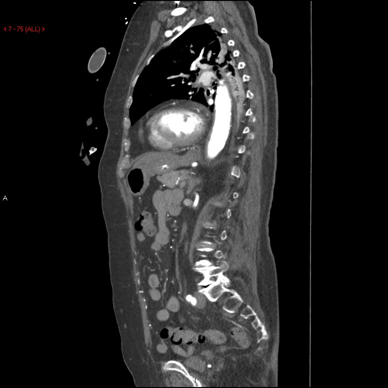 Aortic intramural hematoma (Radiopaedia 27746-28001 C 44).jpg