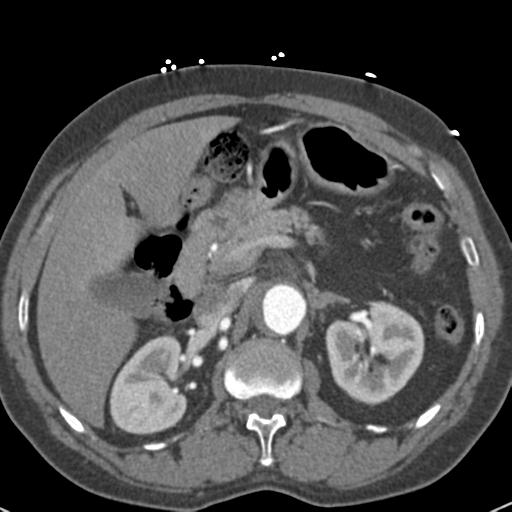 Aortic intramural hematoma (Radiopaedia 31139-31838 B 93).jpg