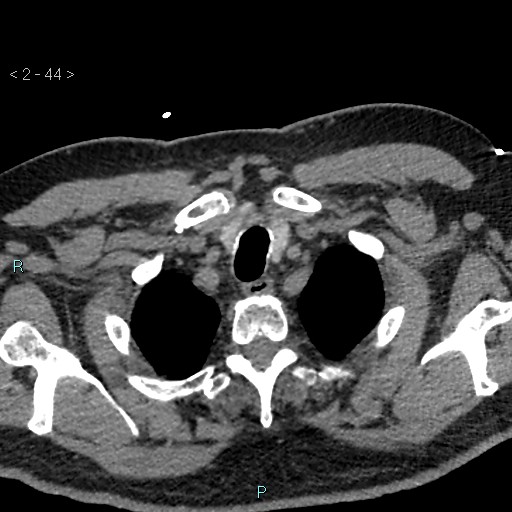Aortic intramural hematoma (Radiopaedia 48463-53380 Axial non-contrast 20).jpg