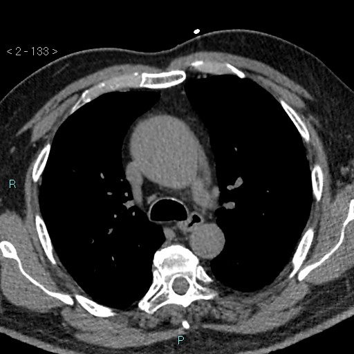 Aortic intramural hematoma (Radiopaedia 48463-53380 Axial non-contrast 59).jpg