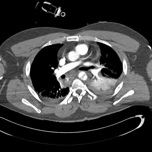 Aortic transection, diaphragmatic rupture and hemoperitoneum in a complex multitrauma patient (Radiopaedia 31701-32622 A 40).jpg