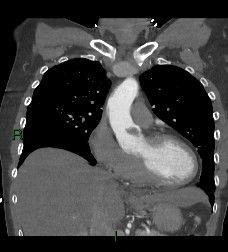 Aortic valve endocarditis (Radiopaedia 87209-103485 D 44).jpg