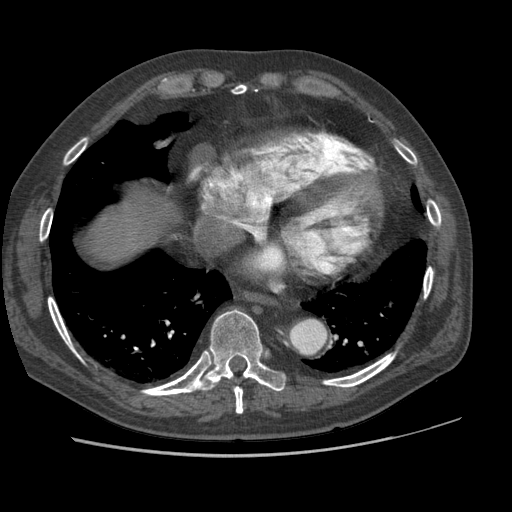 File:Aorto-coronary bypass graft aneurysms (Radiopaedia 40562-43157 A 89).png