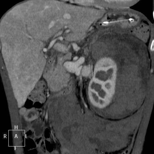Aorto-left renal vein fistula (Radiopaedia 45534-49628 B 21).jpg