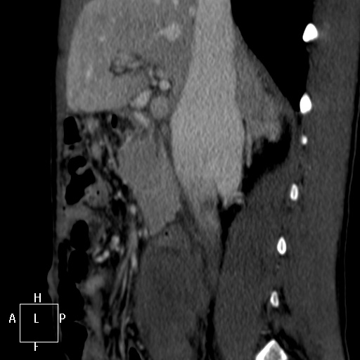 Aorto-left renal vein fistula (Radiopaedia 45534-49628 C 17).jpg