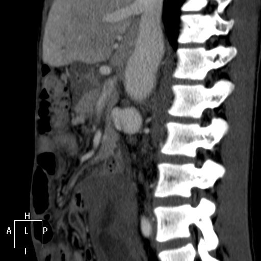 Aorto-left renal vein fistula (Radiopaedia 45534-49628 C 26).jpg
