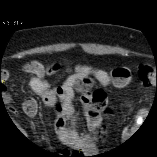File:Aortoiliac occlusive disease (Radiopaedia 16828-16548 A 81).jpg
