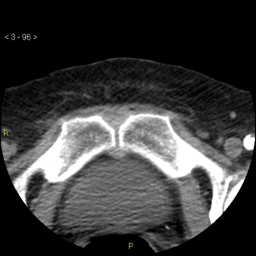 Aortoiliac occlusive disease (Radiopaedia 16828-16548 A 96).jpg