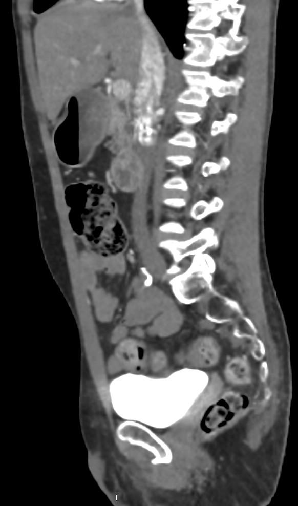 Aortoiliac occlusive disease (Radiopaedia 89182-106053 C 20).jpg
