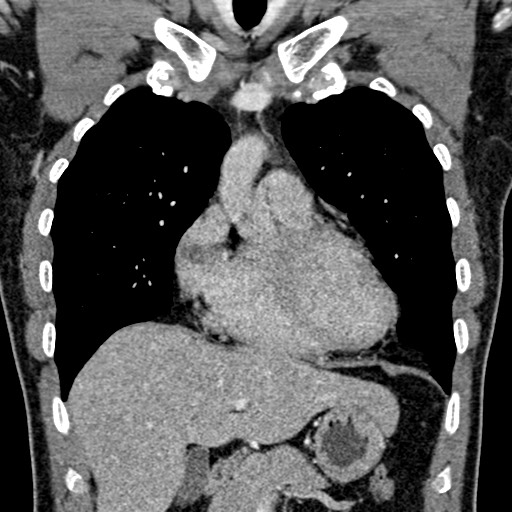 Apical lung mass mimic - neurogenic tumor (Radiopaedia 59918-67521 B 49).jpg