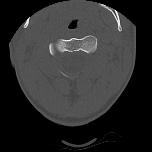 File:Apical pneumothorax on cervical spine CT (Radiopaedia 45343-49368 Axial bone window 19).jpg