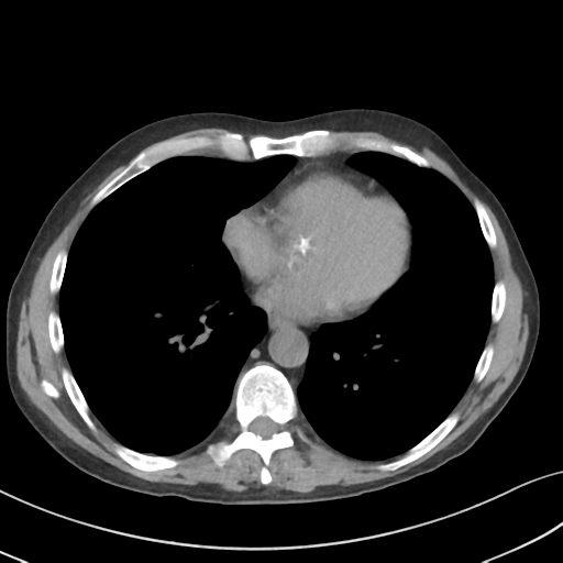 Apical pulmonary metastasis (Radiopaedia 46338-50754 B 41).png