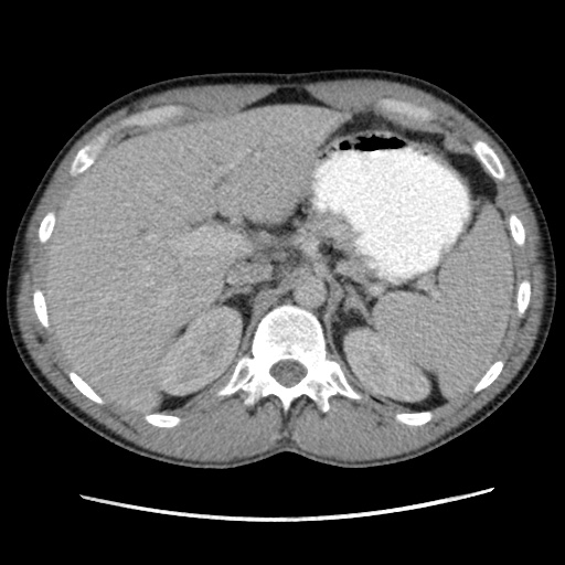 File:Appendicitis complicated by post-operative collection (Radiopaedia 35595-37114 A 23).jpg