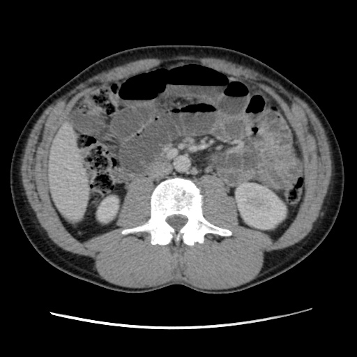 File:Appendicitis complicated by post-operative collection (Radiopaedia 35595-37114 A 41).jpg