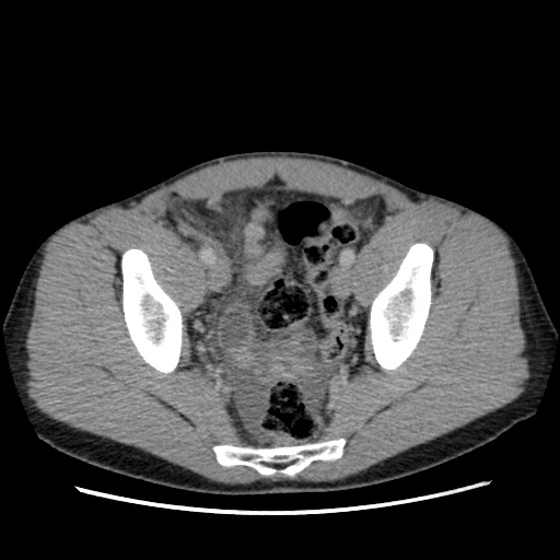 File:Appendicitis complicated by post-operative collection (Radiopaedia 35595-37114 A 74).jpg
