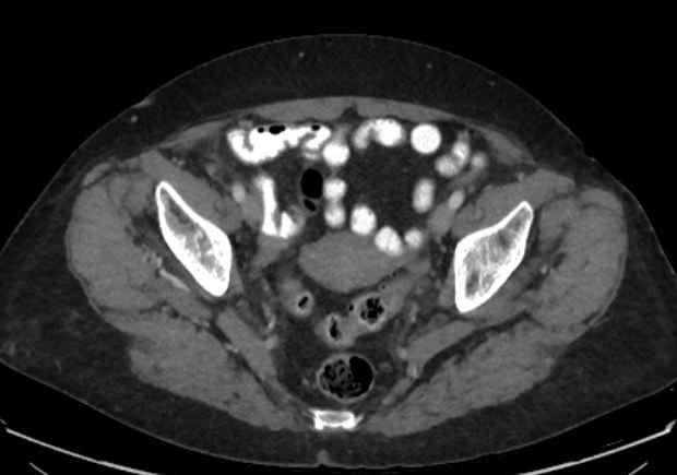 Appendicitis due to chicken fibula (Radiopaedia 74314-85198 A 44).jpg