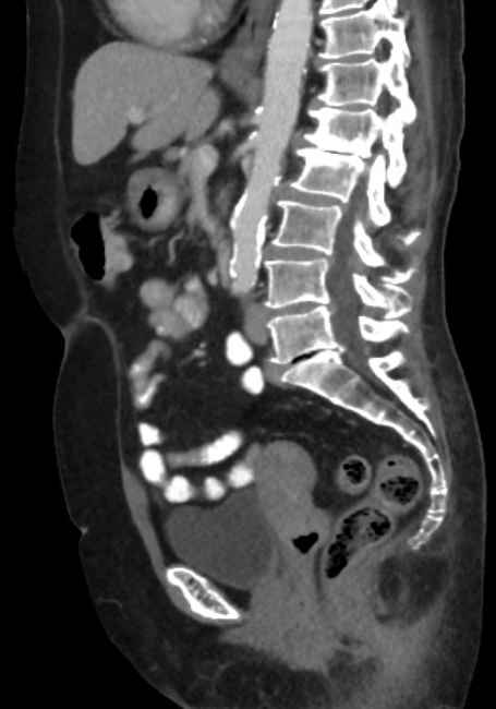 Appendicitis due to chicken fibula (Radiopaedia 74314-85198 C 51).jpg