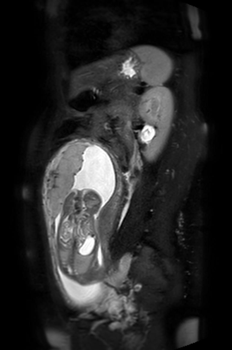 Appendicitis in gravida (MRI) (Radiopaedia 89433-106395 Sagittal T2 SPAIR 23).jpg
