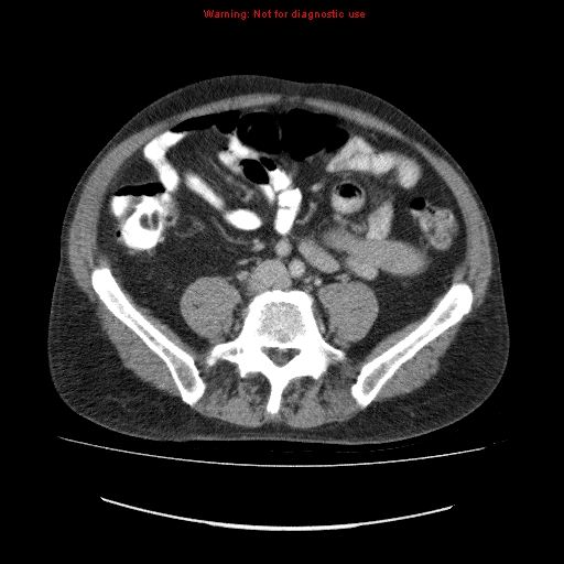 File:Appendicitis mass in inguinal hernia (Radiopaedia 26858-27029 A 1).jpg