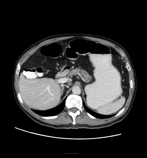 File:Appendicitis with localized perforation and abscess formation (Radiopaedia 49035-54130 A 27).jpg