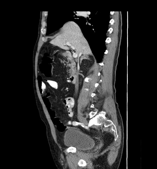 Appendicitis with localized perforation and abscess formation (Radiopaedia 49035-54130 C 26).jpg