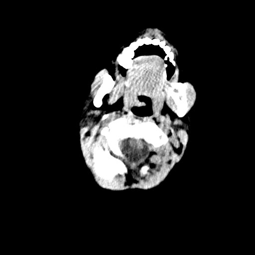 Arachnoid cyst-posterior fossa (Radiopaedia 88661-105370 Axial non-contrast 5).jpg