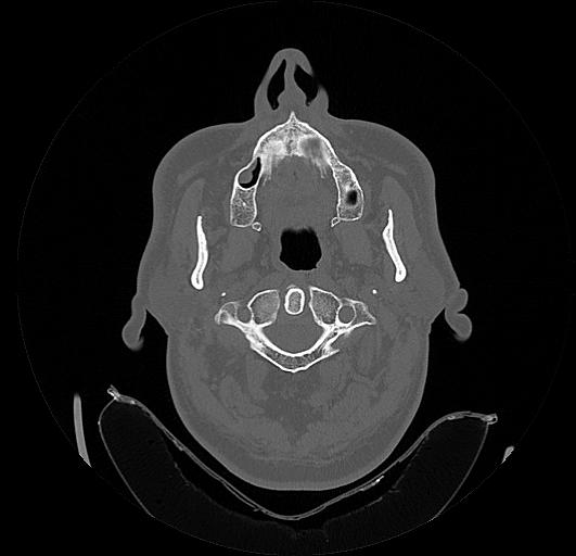 Arcuate foramen (Radiopaedia 89833-106944 Axial bone window 30).jpg
